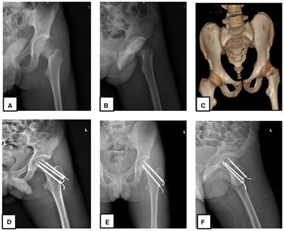 Postoperative clinical outcome and complications of combined cannulated cancellous screw with Kirschner wire in adolescent femoral neck fractures